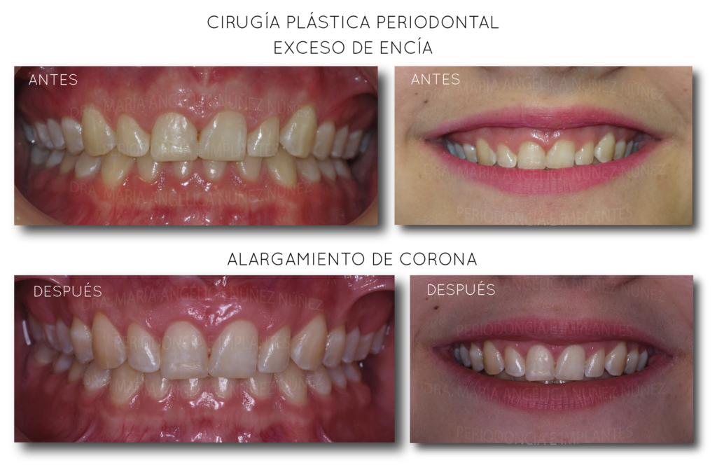 ALARGAMIENTO-DE-CORONA