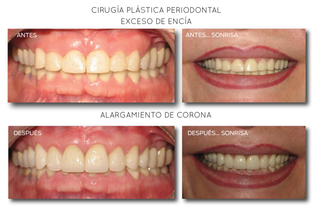 ALARGAMIENTO-DE-CORONA-3