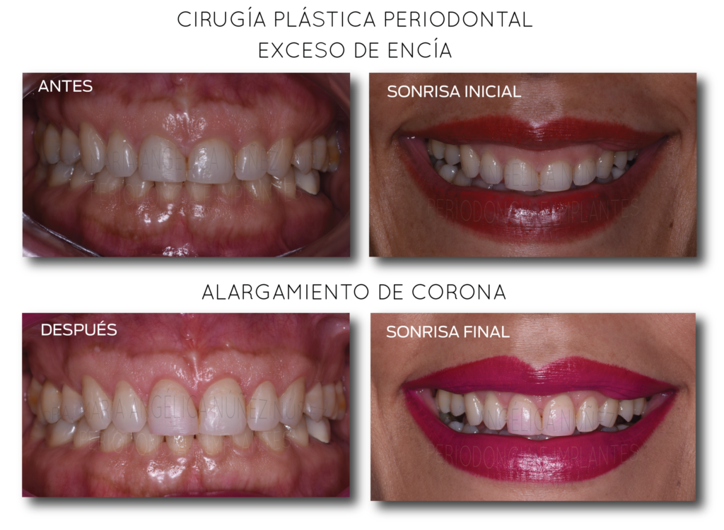ALARGAMIENTO-DE-CORONA-4