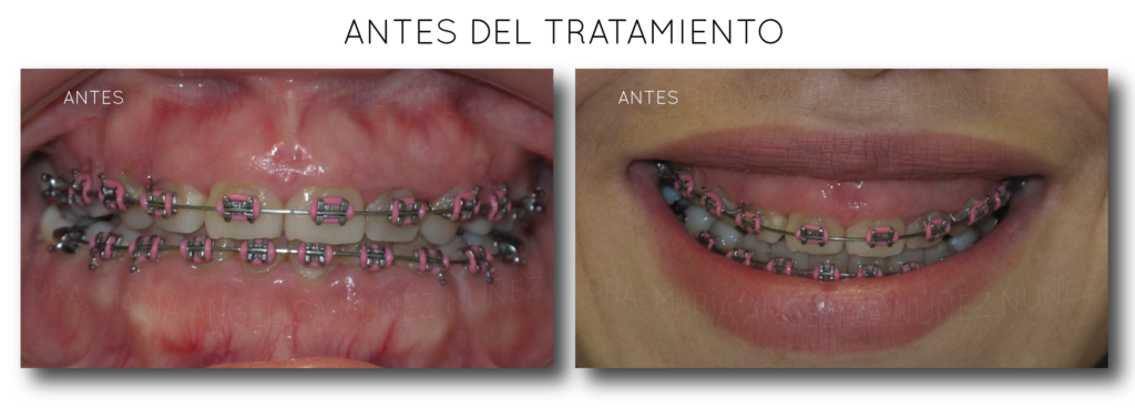 antes-del-alargamiento