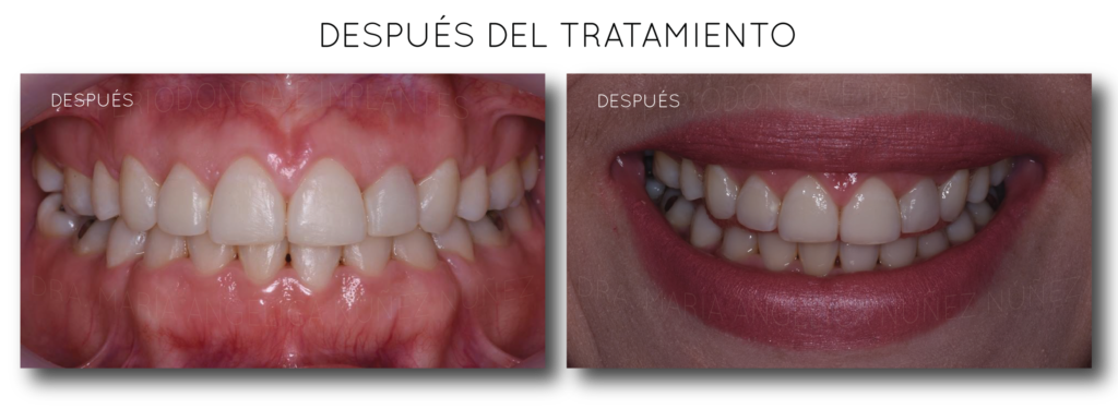 despues-del-alargamiento